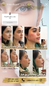 نمونه کار زاویه سازی صورت دکتر اسلامی در ساری