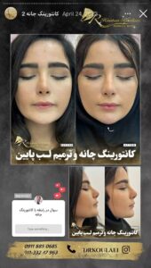 نمونه کار زاویه سازی صورت دکتر اسلامی در ساری