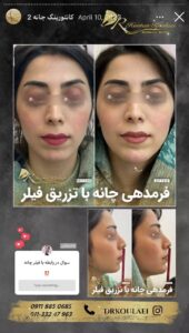 نمونه کار زاویه سازی صورت دکتر اسلامی در ساری