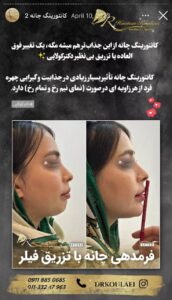 نمونه کار زاویه سازی صورت دکتر اسلامی در ساری