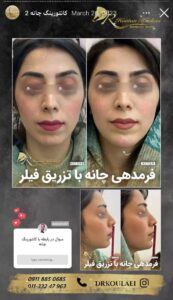 نمونه کار زاویه سازی صورت دکتر اسلامی در ساری