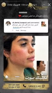 نمونه کار زاویه سازی صورت دکتر اسلامی در ساری