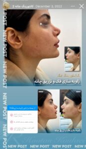 نمونه کار زاویه سازی صورت دکتر اسلامی در ساری