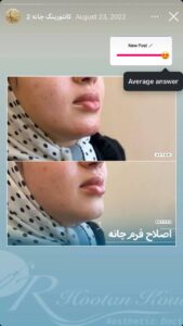 نمونه کار زاویه سازی صورت دکتر اسلامی در ساری