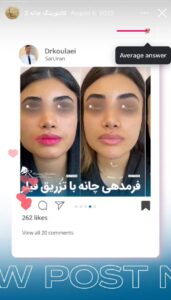 نمونه کار زاویه سازی صورت دکتر اسلامی در ساری