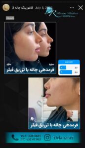 نمونه کار زاویه سازی صورت دکتر اسلامی در ساری