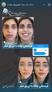 نمونه کار زاویه سازی صورت دکتر اسلامی در ساری