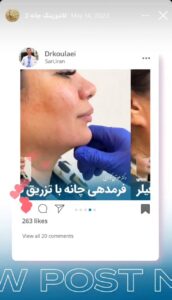 نمونه کار زاویه سازی صورت دکتر اسلامی در ساری