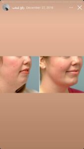 نمونه کار زاویه سازی صورت کلینیک باران در ساری