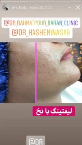 نمونه کار زاویه سازی صورت کلینیک باران در ساری