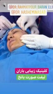 نمونه کار زاویه سازی صورت کلینیک باران در ساری