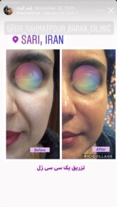 نمونه کار زاویه سازی صورت کلینیک باران در ساری