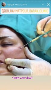 نمونه کار زاویه سازی صورت کلینیک باران در ساری