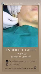 نمونه کار زاویه سازی صورت کلینیک باران در ساری