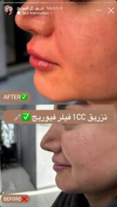 نمونه کار زاویه سازی صورت کلینیک باران در ساری