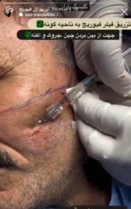 نمونه کار زاویه سازی صورت کلینیک باران در ساری