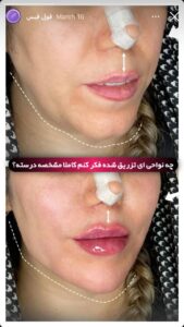 نمونه کار زاویه سازی صورت کلینیک کاژه