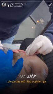 نمونه کار زاویه سازی صورت کلینیک کاژه