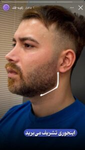 نمونه کار زاویه سازی صورت کلینیک کاژه