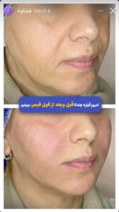 نمونه کار زاویه سازی صورت کلینیک کاژه