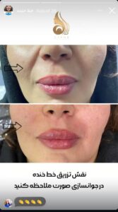 نمونه کار زاویه سازی صورت کلینیک کاژه