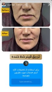 نمونه کار زاویه سازی صورت کلینیک کاژه