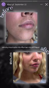 نمونه کار زاویه سازی صورت کلینیک کاژه