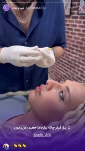 نمونه کار زاویه سازی صورت کلینیک کاژه