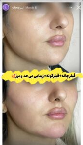 نمونه کار زاویه سازی صورت کلینیک کاژه
