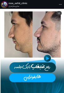 نمونه کار زاویه سازی صورت کلینیک رز سفید در ساری