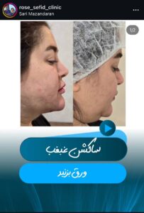 نمونه کار زاویه سازی صورت کلینیک رز سفید در ساری