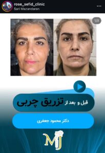 نمونه کار زاویه سازی صورت کلینیک رز سفید در ساری
