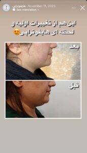 نمونه کار زاویه سازی صورت کلینیک رز سفید در ساری