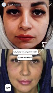 نمونه کار زاویه سازی صورت کلینیک رز سفید در ساری