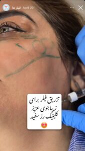 نمونه کار زاویه سازی صورت کلینیک رز سفید در ساری