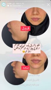 نمونه کار زاویه سازی صورت کلینیک برنا در ساری