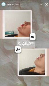 نمونه کار زاویه سازی صورت کلینیک برنا در ساری