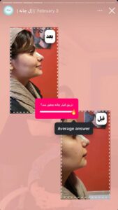 نمونه کار زاویه سازی صورت کلینیک برنا در ساری