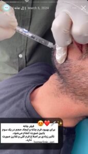 نمونه کار زاویه سازی صورت کلینیک برنا در ساری