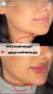 نمونه کار زاویه سازی صورت کلینیک برنا در ساری