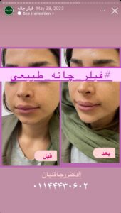 نمونه کار زاویه سازی صورت دکتر رجا قلیان در ساری