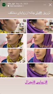 نمونه کار زاویه سازی صورت دکتر رجا قلیان در ساری