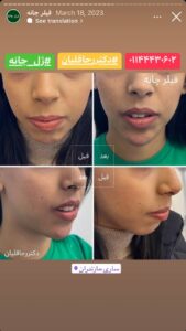 نمونه کار زاویه سازی صورت دکتر رجا قلیان در ساری