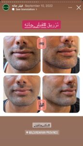 نمونه کار زاویه سازی صورت دکتر رجا قلیان در ساری