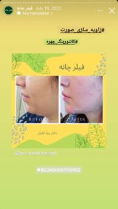 نمونه کار زاویه سازی صورت دکتر رجا قلیان در ساری