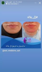 نمونه کار زاویه سازی صورت دکتر رجا قلیان در ساری