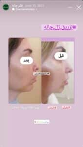 نمونه کار زاویه سازی صورت دکتر رجا قلیان در ساری