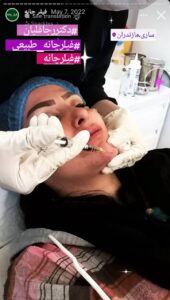 نمونه کار زاویه سازی صورت دکتر رجا قلیان در ساری