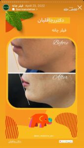 نمونه کار زاویه سازی صورت دکتر رجا قلیان در ساری