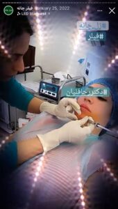 نمونه کار زاویه سازی صورت دکتر رجا قلیان در ساری